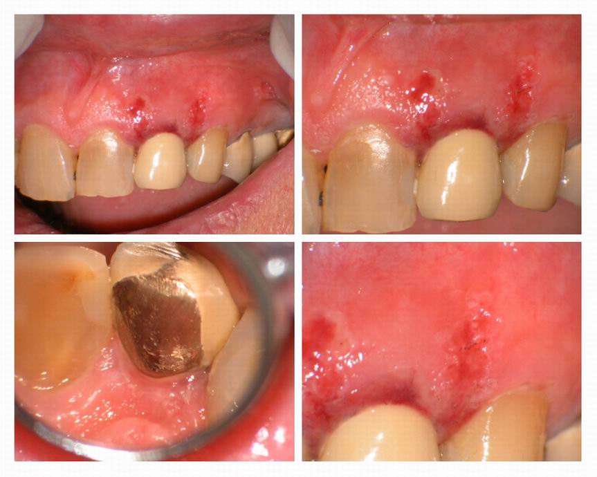 Resize of 1 day healing on tissue.jpg